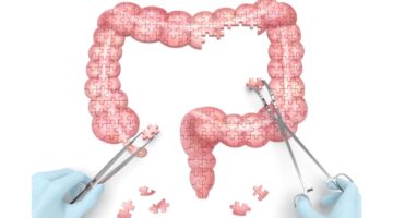 Rinvoq de Abbvie podría convertirse en el primer inhibidor para la enfermedad de Crohn