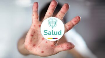 Sarampión en Colombia: MinSalud intensifica vacunación y vigilancia con la Circular 004 de 2026