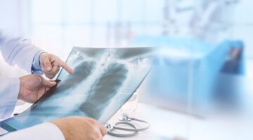 Se aprueba alectinib en Colombia para cáncer de pulmón ALK-positivo