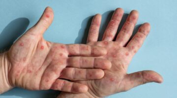 Secretaría de Salud de Bogotá presentó plan de acción sobre viruela del mono