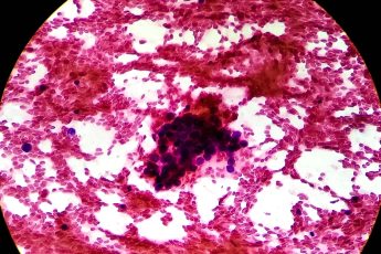 Transformando el diagnóstico del carcinoma hepatocelular con inteligencia artificial