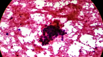 Transformando el diagnóstico del carcinoma hepatocelular con inteligencia artificial