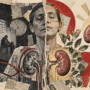 Trasplante renal frente a diálisis estudio muestra que el beneficio varía según la edad y el tipo de donante