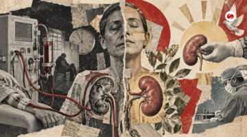 Trasplante renal frente a diálisis estudio muestra que el beneficio varía según la edad y el tipo de donante
