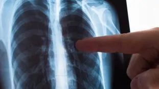 Tuberculosis: OMS advierte retroceso global por recortes en salud y exige acción urgente
