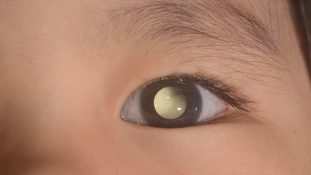 Un virus ayuda a tratar el retinoblastoma en niños