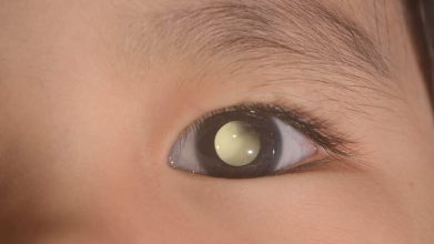 Un virus ayuda a tratar el retinoblastoma en niños