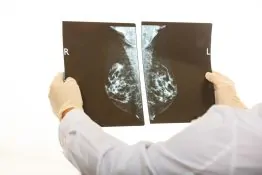 Vinculan 17 genes a la remisión en cáncer de mama triple negativo