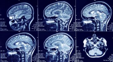 Vinculan actividad en zona del cerebro al desarrollo de la ansiedad y la depresión