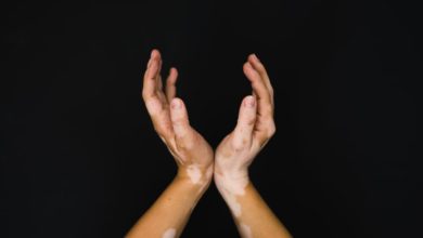 Vitiligo Causas, síntomas y tratamientos