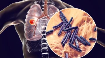 Washington registra su peor brote de tuberculosis en 20 años