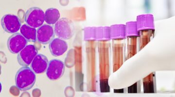 Zanubrutinib, nuevo medicamento para la leucemia linfocítica crónica