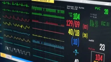 ALGUNAS ARRITMIAS PREEXISTENTES SOLO SE DETECTAN TRAS EL REEMPLAZO DE VÁLVULA AÓRTICA