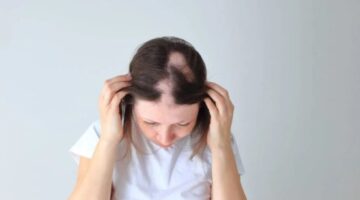 FDA aprobó de JAK Deuruxolitinib para la alopecia areata