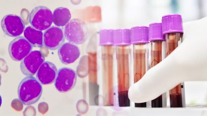 aprueban nueva terapia car-t para la leucemia en adultos