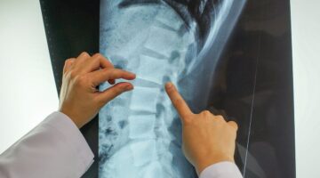 Primer medicamento oral atrofia muscular espinal