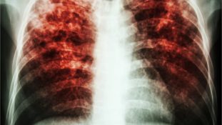 aumentan muertes por tuberculosis por primera vez en 10 años