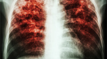 aumentan muertes por tuberculosis por primera vez en 10 años