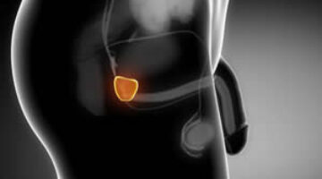 Guía cáncer de próstata GPC