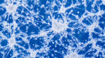 casos de autismo y glioblastoma tendrian el mismo origen