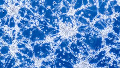 casos de autismo y glioblastoma tendrian el mismo origen