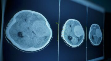 con modelo predictivo clasifican tumores cerebrales segun agresividad