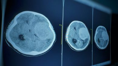 con modelo predictivo clasifican tumores cerebrales segun agresividad