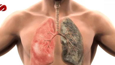 Crean Nuevo Software permite detectar el cáncer de pulmón