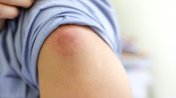 cuales vacunas efectos secundarios Colombia