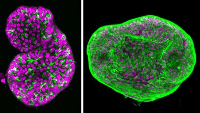 descubren diana terapeutica para cancer de prostata neuroendocrino con organoides. Foto Ankur Singh