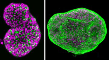 descubren diana terapeutica para cancer de prostata neuroendocrino con organoides. Foto Ankur Singh