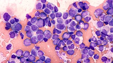 descubren otros factores implicados en el desarrollo de leucemia