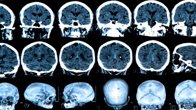 enfermedad de Huntington