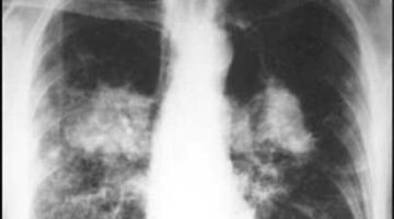 FIBROSIS QUISTICA