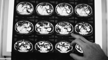 guia internacional tratamiento complicaciones tumores cerebrales