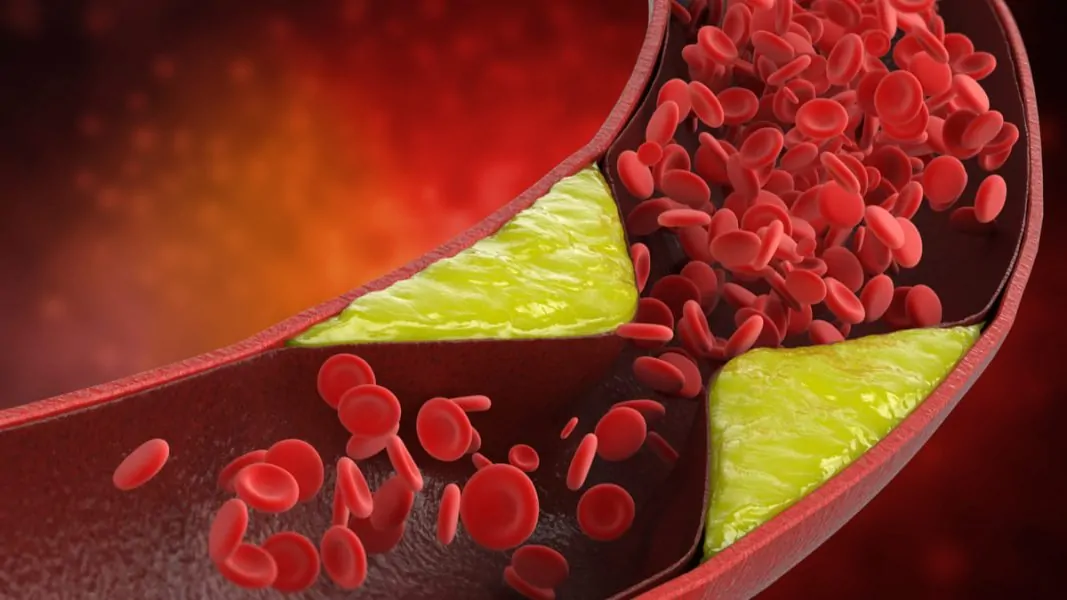 hiperlipidemia mixta colombia big data
