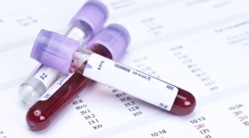 Uso de inhibidores SGLT2 asociados a triple riesgo de cetoacidosis diabetica