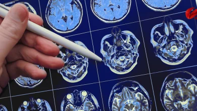 La epilepsia y el gran desafío que enfrenta América latina