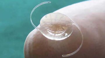 Alerta Sanitaria: Lentes Intraoculares Acrílicos