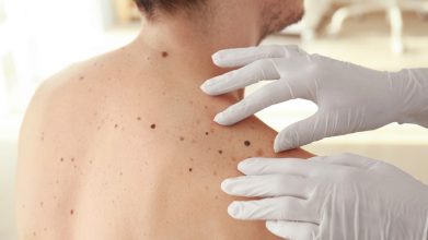 melanoma