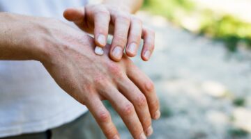psoriasis