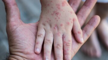 Sarampión y Rubeola