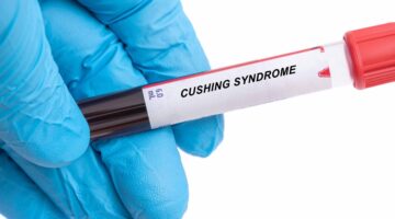 Día Mundial del Síndrome de Cushing: cerca del 5% de los colombianos podrían tener esta enfermedad y aún no estar diagnosticados