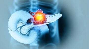 cáncer de páncreas