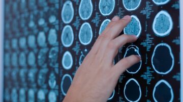 Colesterol muy bajo aumenta riesgo de accidente cerebrovascular hemorrágico