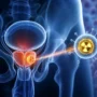 Terapia radioactiva dirigida podría retrasar la progresión del cáncer de próstata recurrente, según estudio internacional