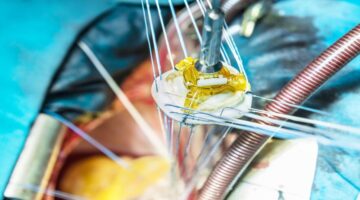 Válvula mitral transcatéter pone a prueba Estados Unidos