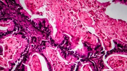 ¿Cómo la IA puede detectar un caso de cáncer entre millones de imágenes
