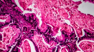 ¿Cómo la IA puede detectar un caso de cáncer entre millones de imágenes