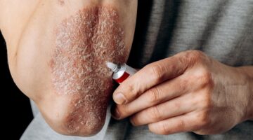 ¿Qué es la enfermedad psoriásica